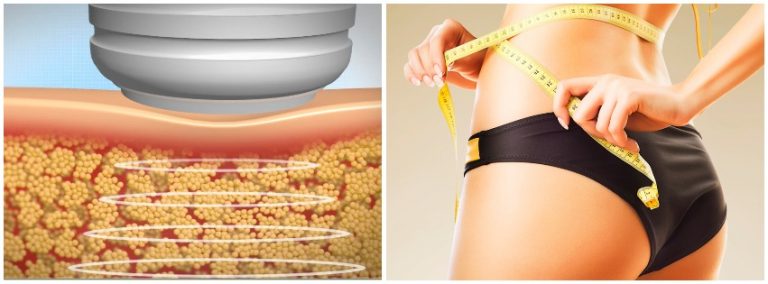 4 Димензионална Кавитација – 4D Ultrasonic Cavitation