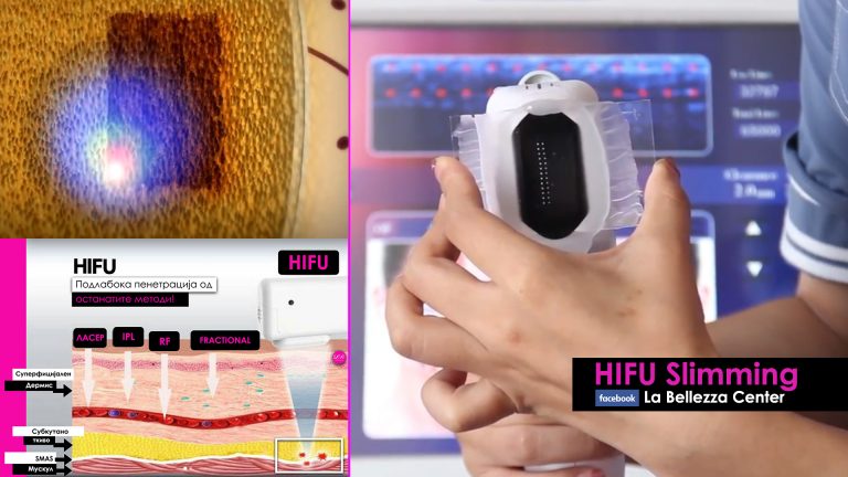 HIFU: нова технологија за таргетирање на масти, стрии и целулит!