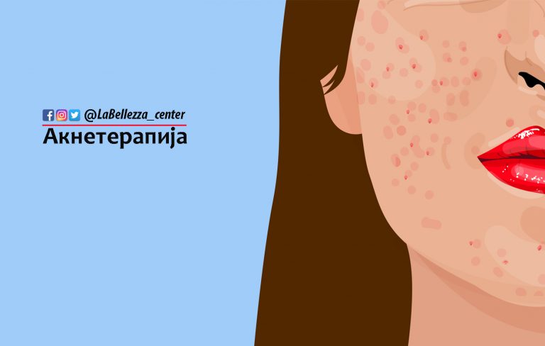 Акнетерапија: Најголем проблем во лето!?