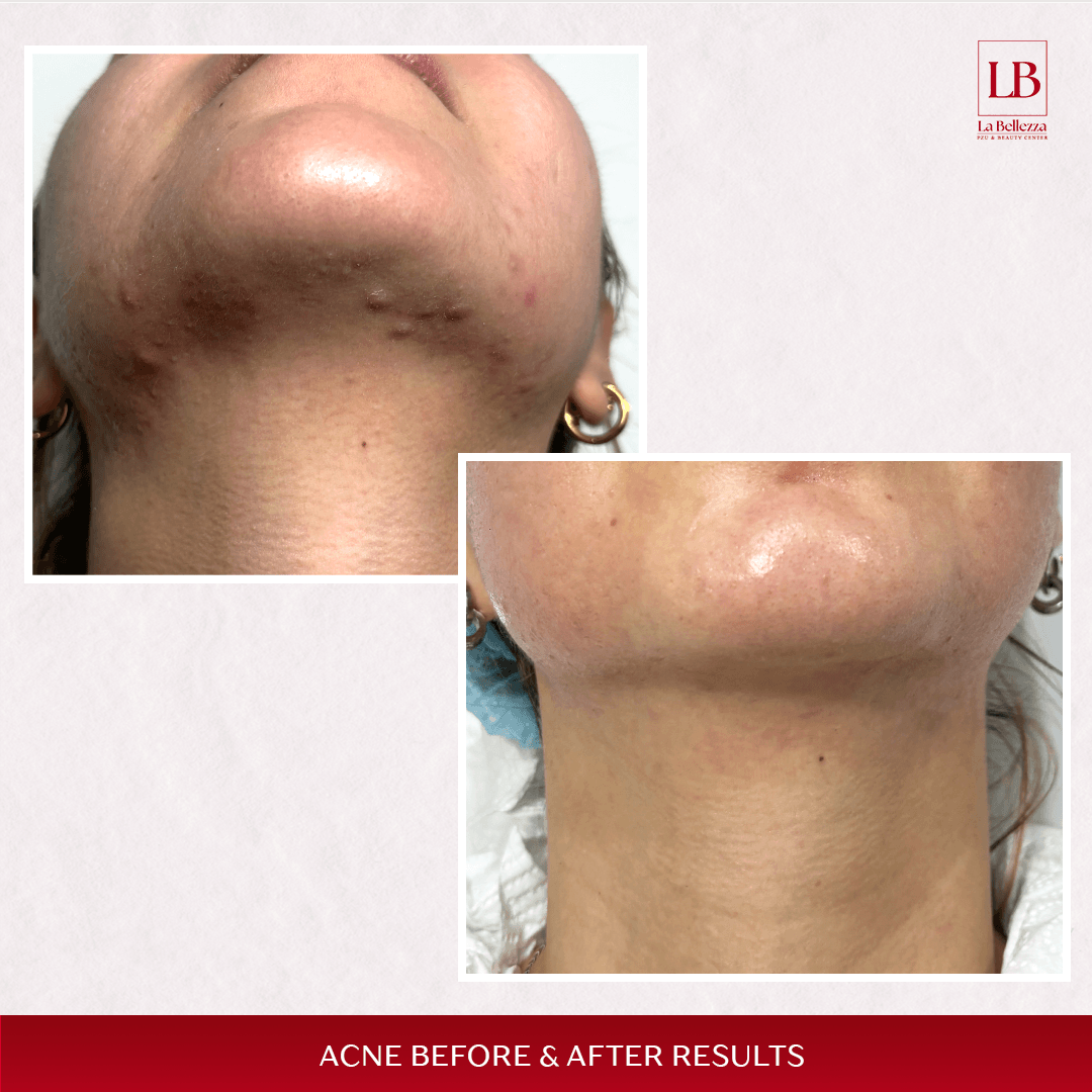 Akni b&a 2 (1)