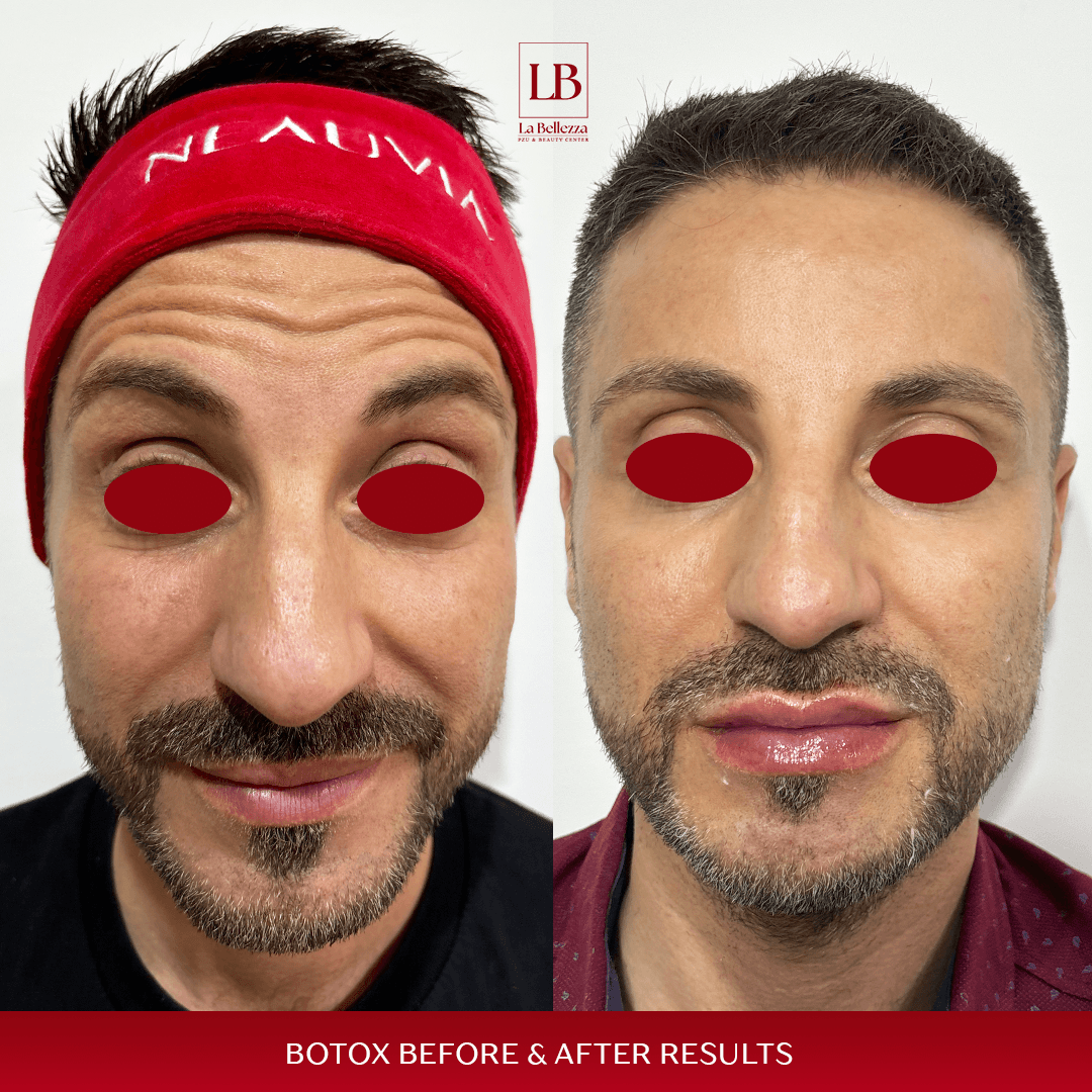 Botoks masko