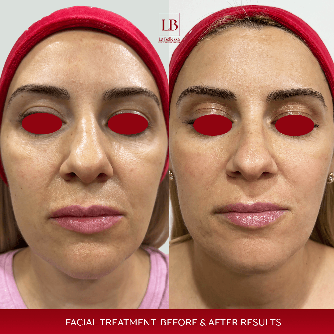 Facial treatment b&a 1 copy 2