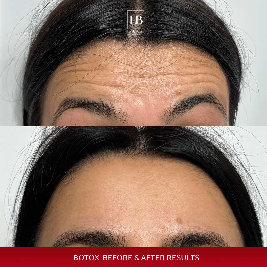 botox celo