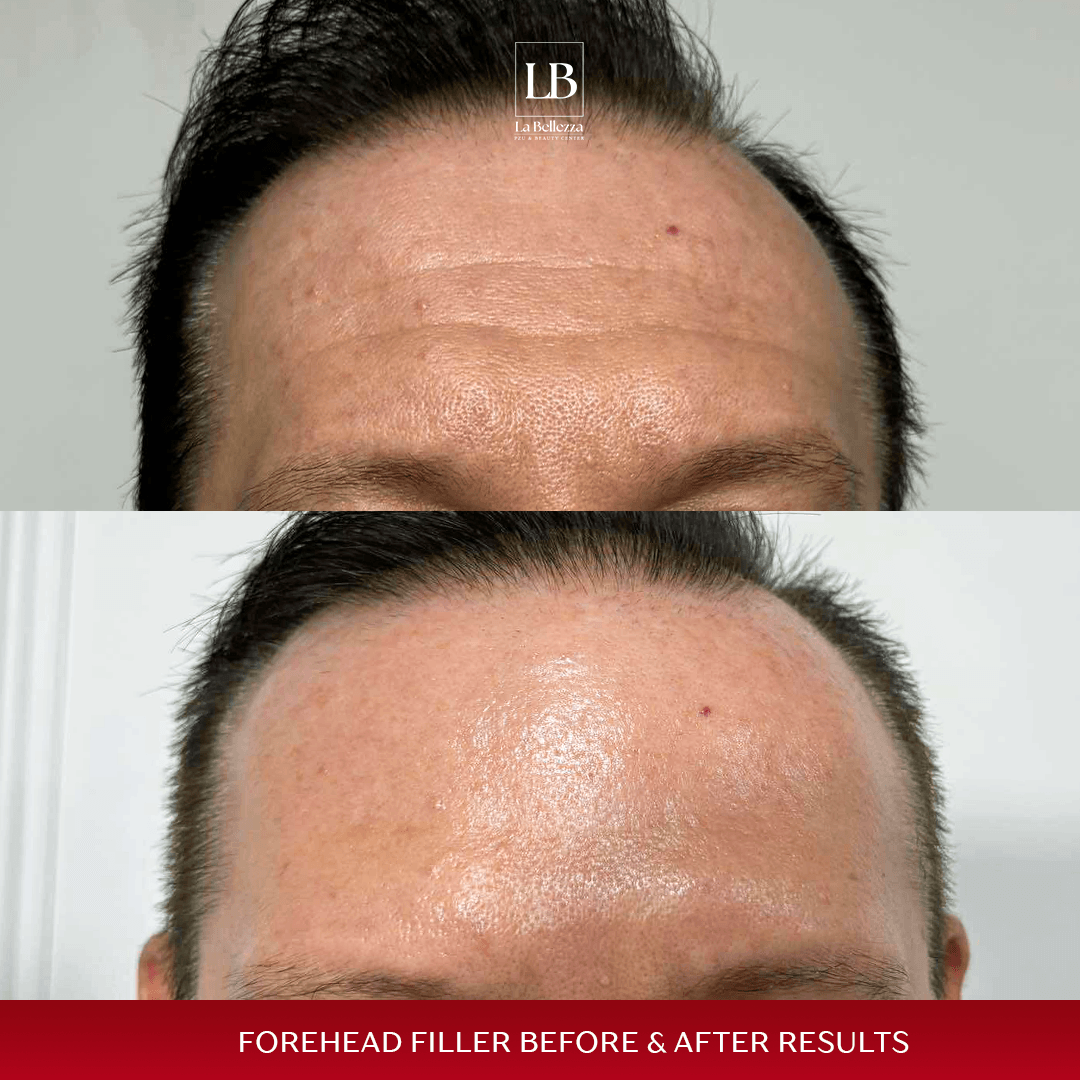 forhead filler b&a 2 copy (1)