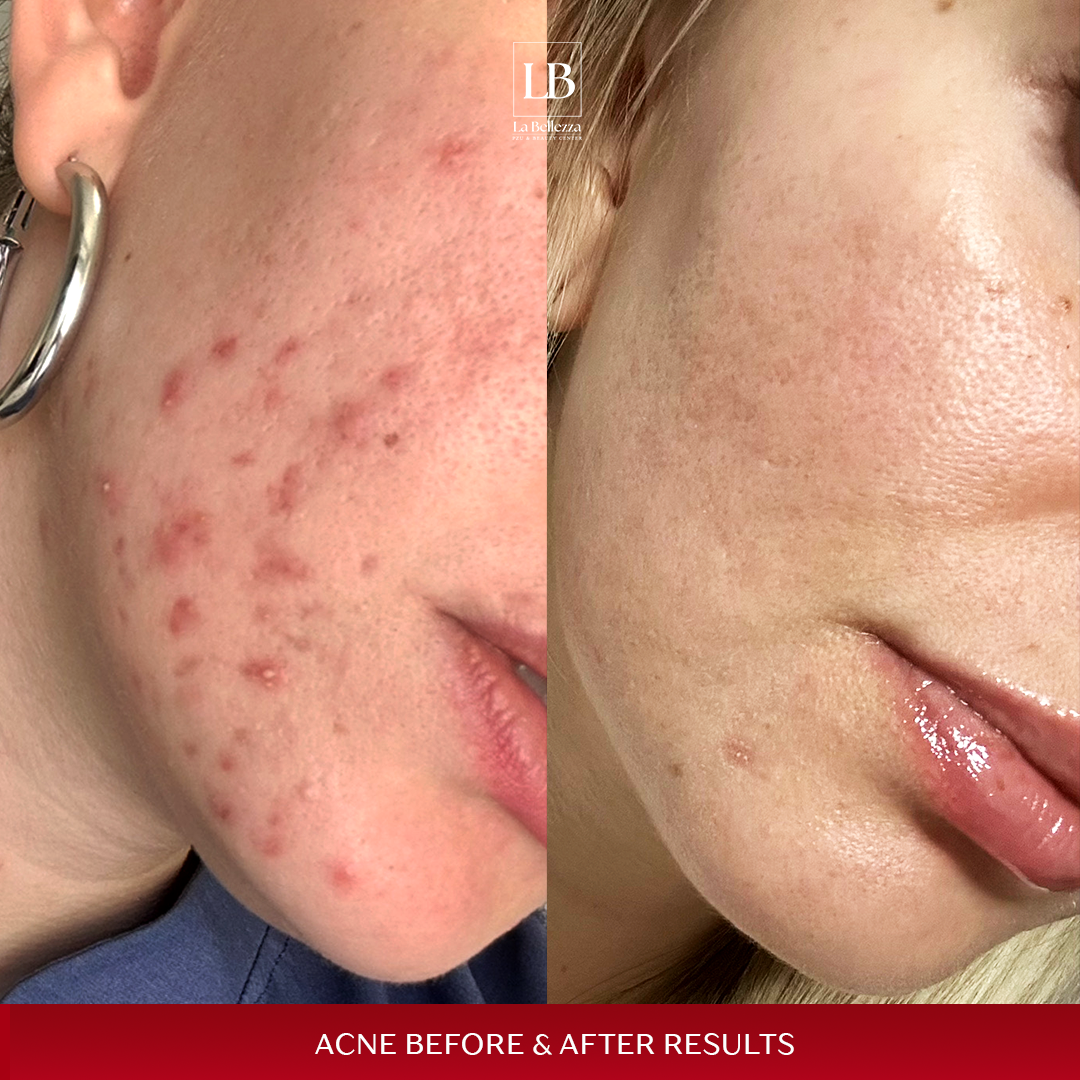 Akni b&a 1