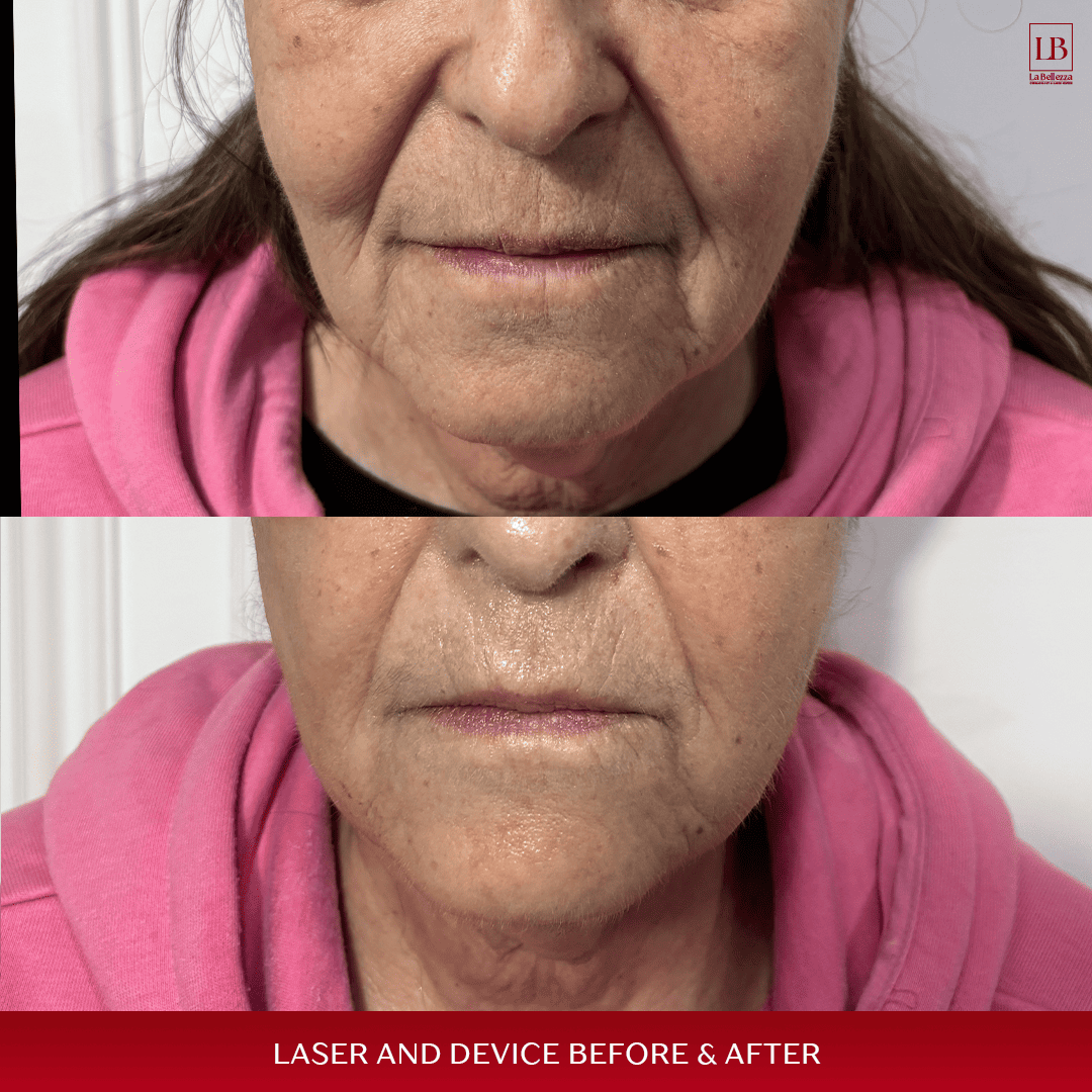 LASER and DEVICE BEFORE & AFTER