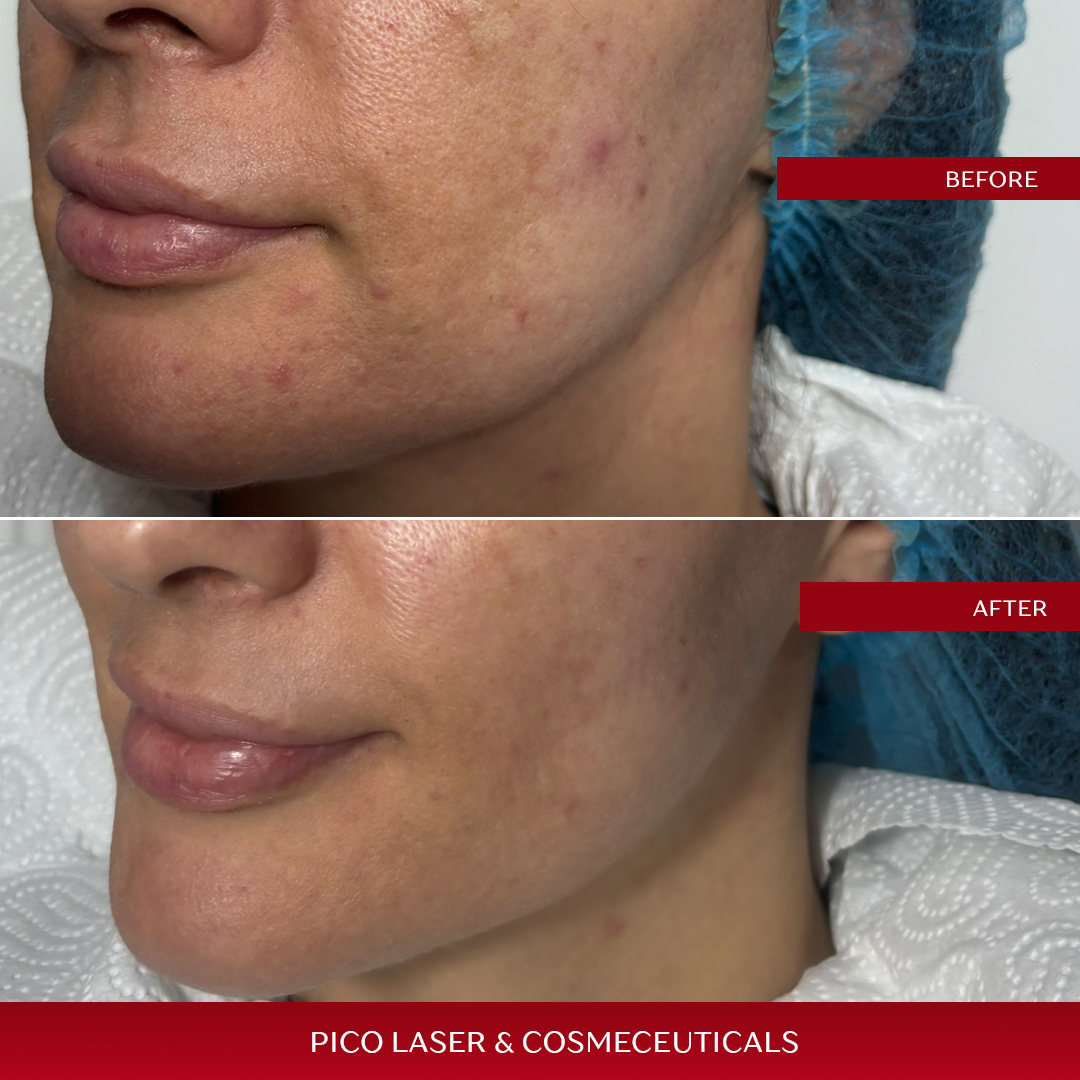 PICO LASER & COSMECEUTICALS - Lilly new