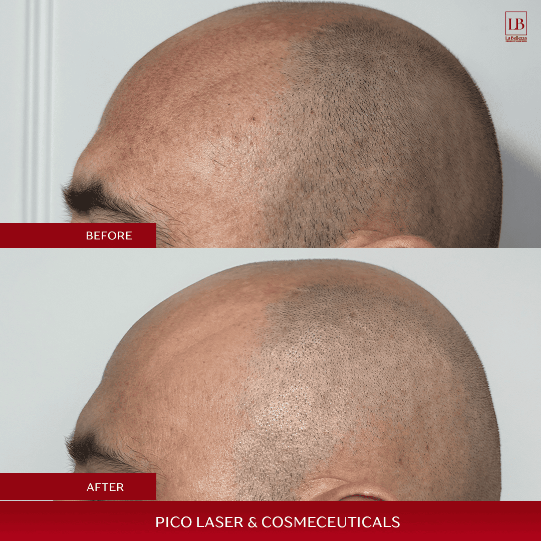 PICO LASER & COSMECEUTICALS