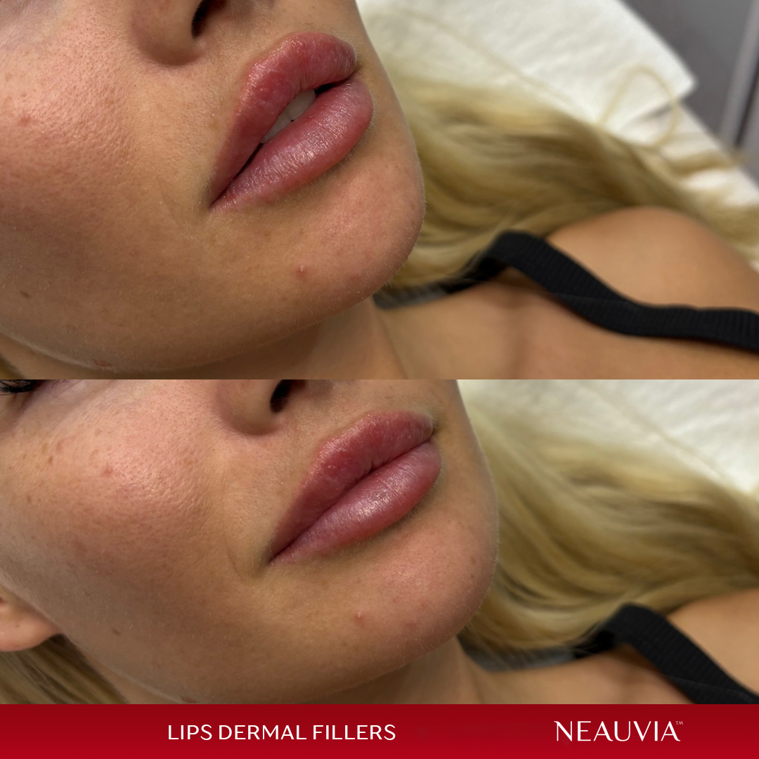 lips-2weeks-after